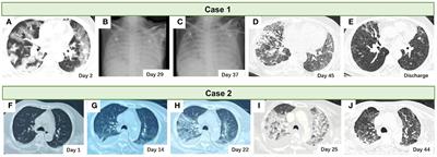 Case report: Enhancing prognosis in severe COVID-19 through human herpes virus coinfection treatment strategies